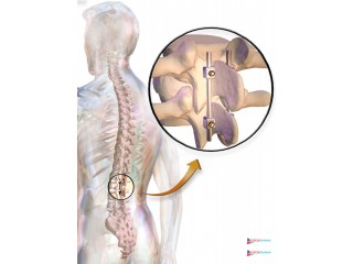 Spinal Fusion Surgery in india