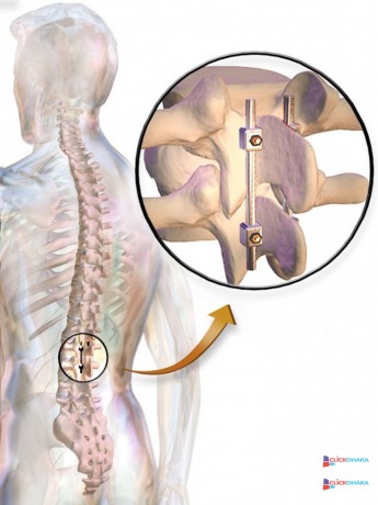 spinal-fusion-surgery-in-india-big-0